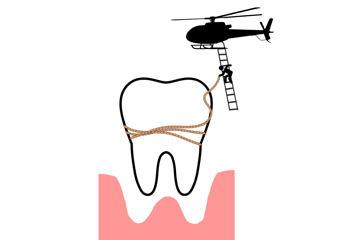 extraction and bone graft