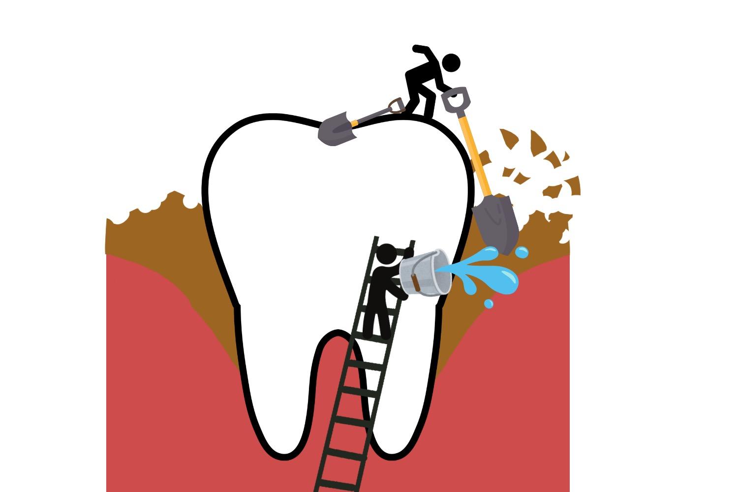 scaling and root planning